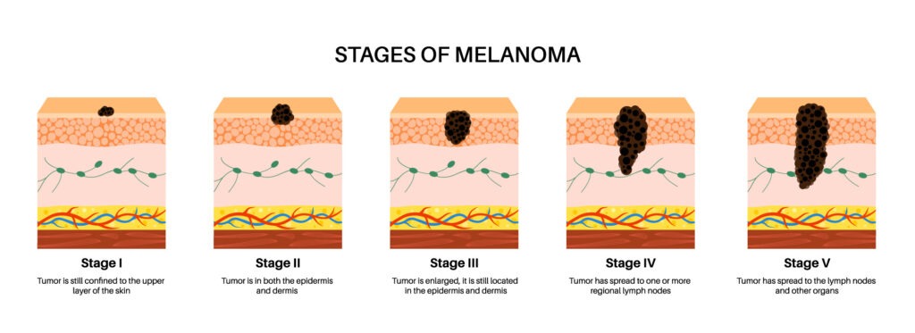 Malignant Melanoma Treatment in Oakland County, MI | SEM Surgical